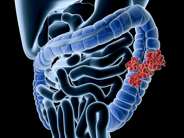 Cancer de colon y ganglios afectados