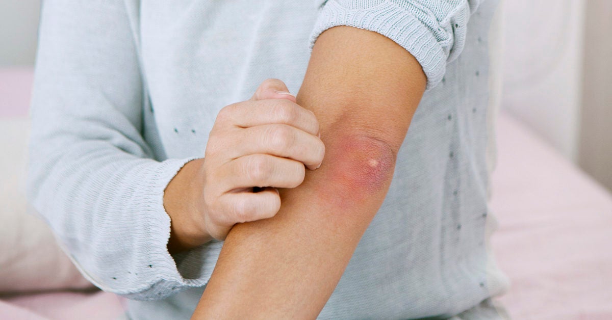 pimple-on-your-elbow-main-causes-and-treatments