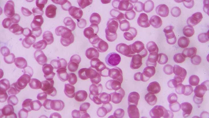 new sickle cell disease treatment new sickle cell disease treatment