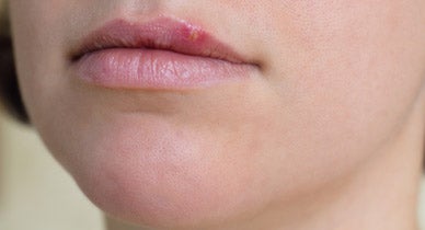 Tiny lips small bumps on White Bumps