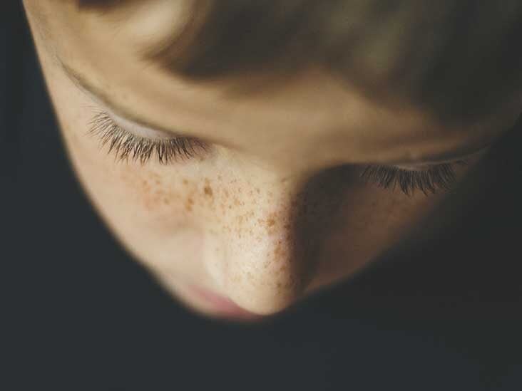 How To Get Rid Of Freckles 7 Ways