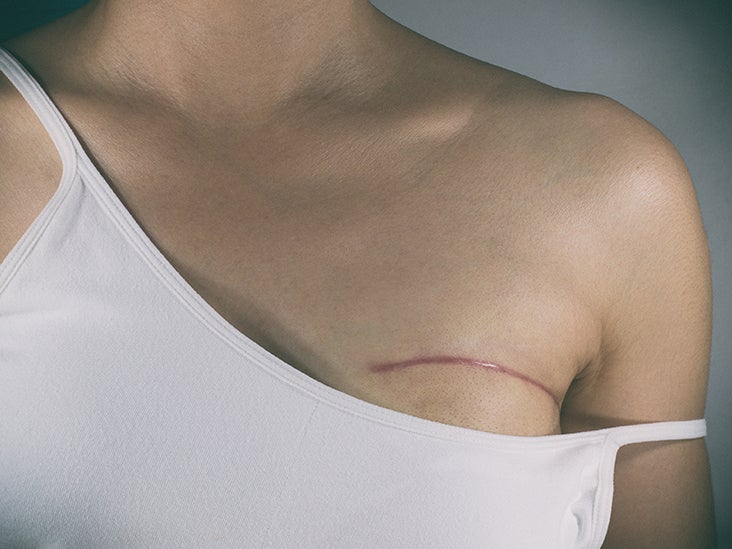 Breast Cancer Treatment Surgery Radiation And More