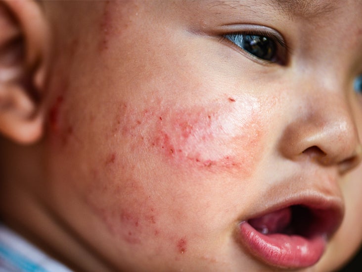 Is Your Baby S Skin Extra Sensitive How To Know