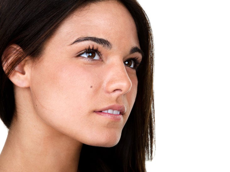 melasma skin
