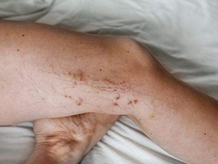 Reticular Veins: Potential Dangers, Pictures, Treatments, and More