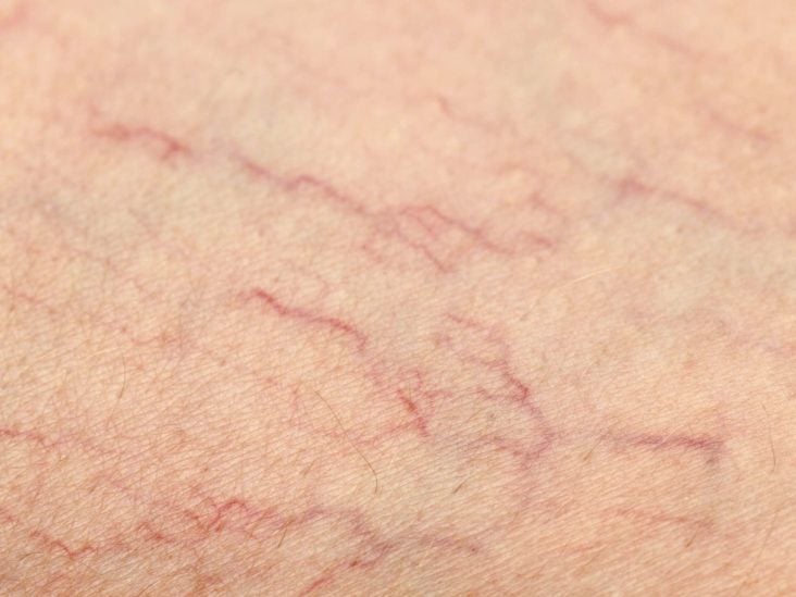 Telangiectasia Causes Diagnosis And Treatment
