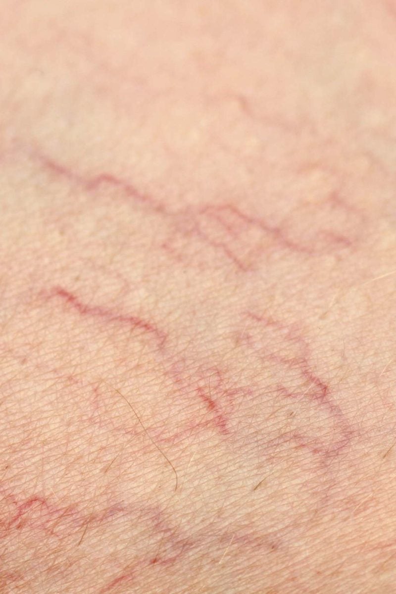 Telangiectasia Causes Diagnosis And Treatment
