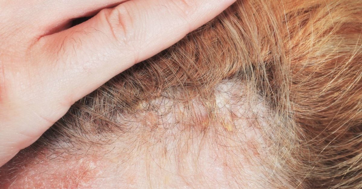 scalp psoriasis en español vörös folt jelent meg a lábán mint egy zúzódás