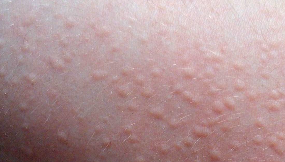 Itchy red bumps from allergic reaction