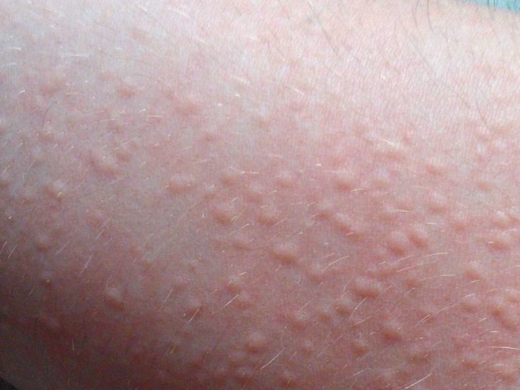 Cholinergic Urticaria Symptoms Treatment And Causes