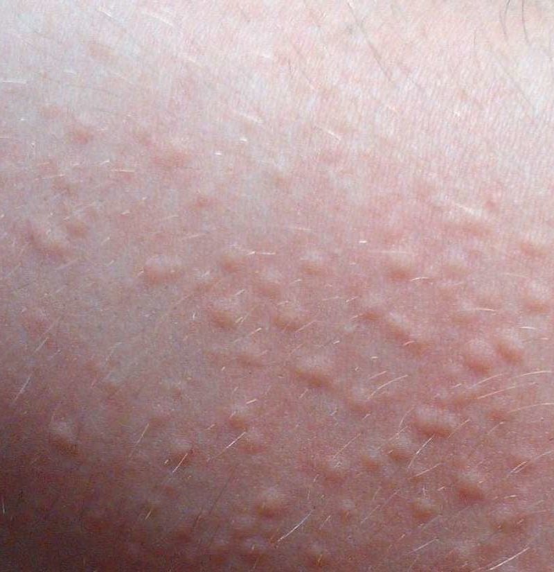 Allergic reaction rash and itching