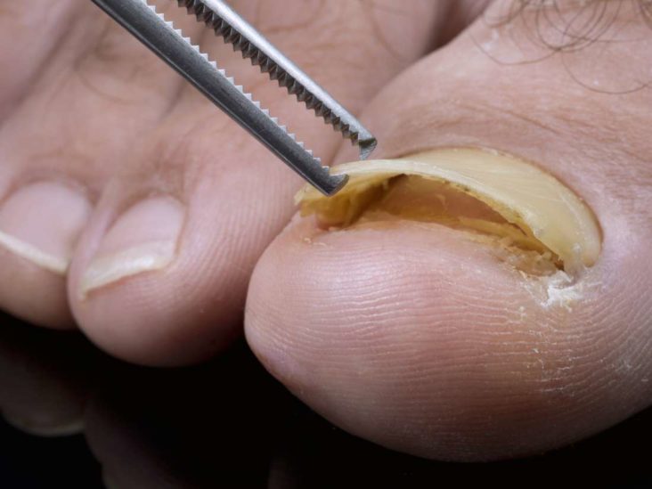 The Simplest Ways To Fix An Ingrown Fingernail