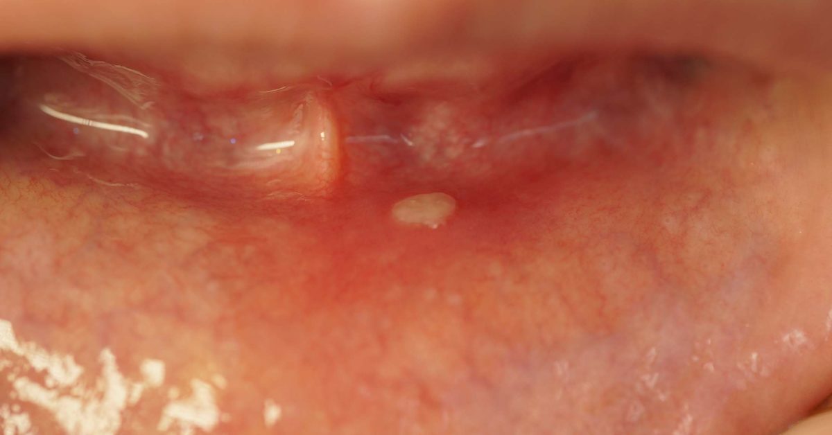 Can Strep Throat Cause White Spots On Gums