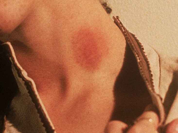 How To Get Rid Of A Hickey Best Home Remedies