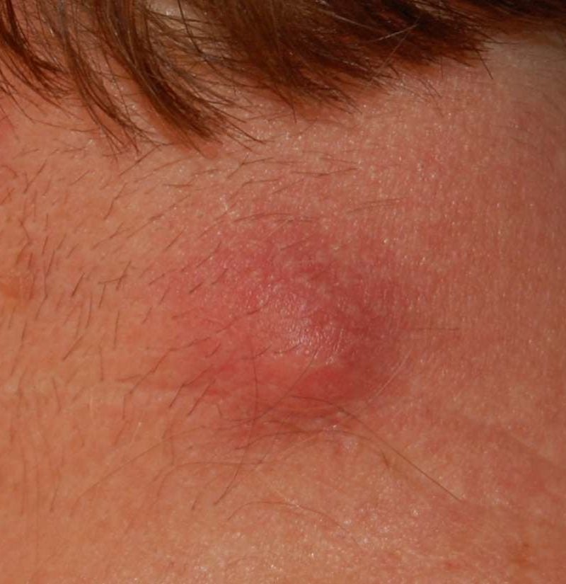 swollen lymph nodes in armpit