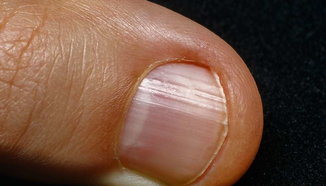 4. Nail Bed Color and Iron Deficiency Anemia - wide 3