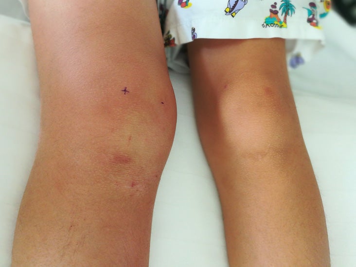 Swollen Knee Causes Treatments And Home Remedies