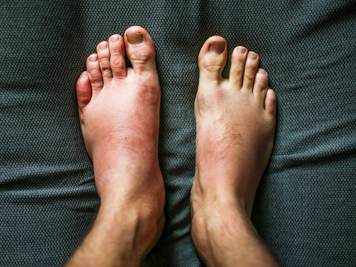 Swelling Is It Serious Symptoms Causes And Treatment