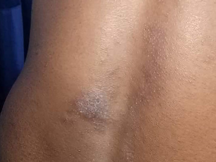 Nummular eczema Causes, symptoms, comparisons, and treatment Nummular eczema Causes, symptoms, comparisons, and treatment
