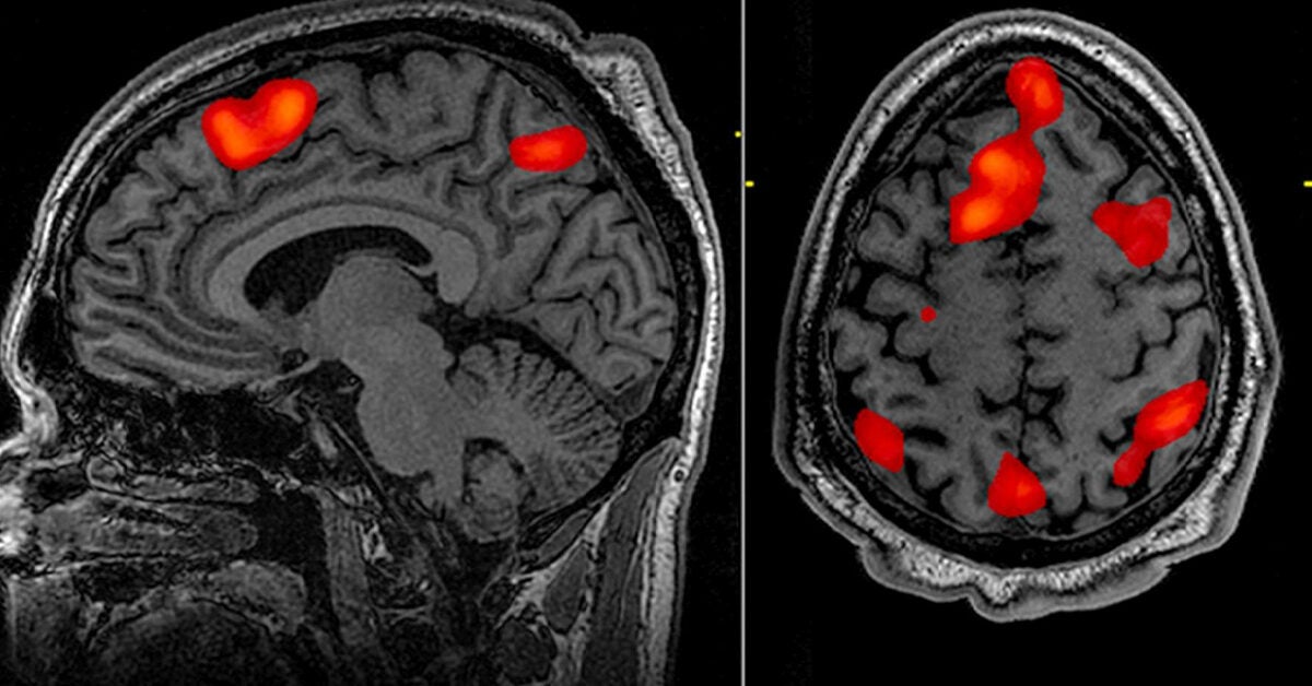 schizophrenia brain scan
